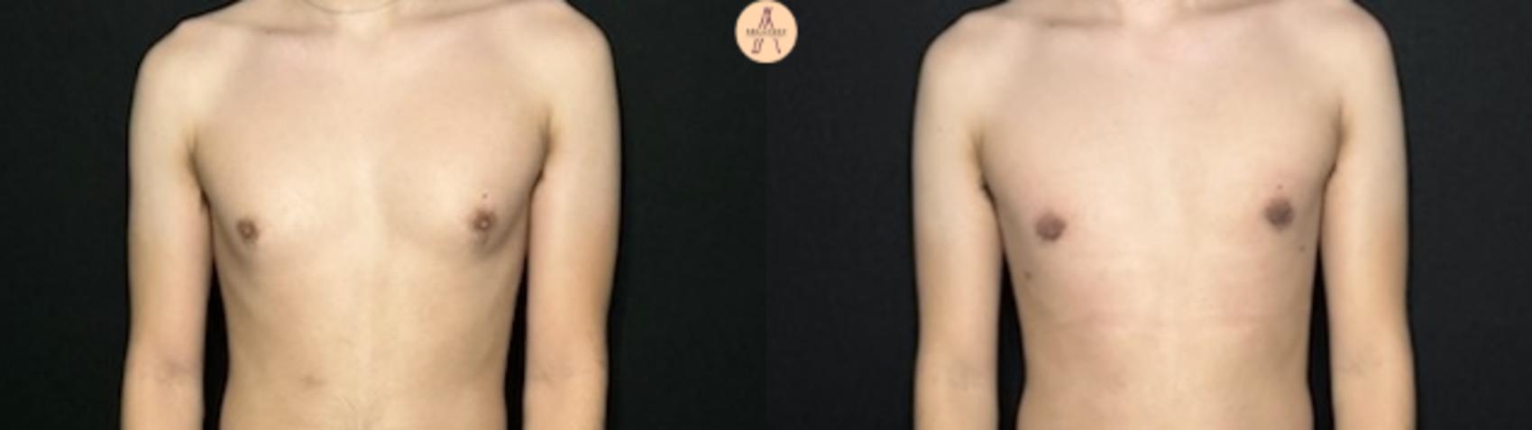 Before & After Liposuction Case 319 Front View in San Antonio, Texas