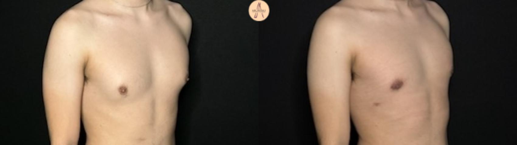 Before & After Liposuction Case 319 Right Oblique View in San Antonio, Texas