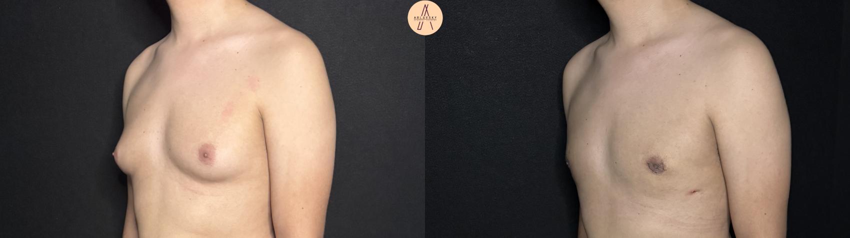 Before & After Liposuction Case 362 Left Oblique View in San Antonio, Texas
