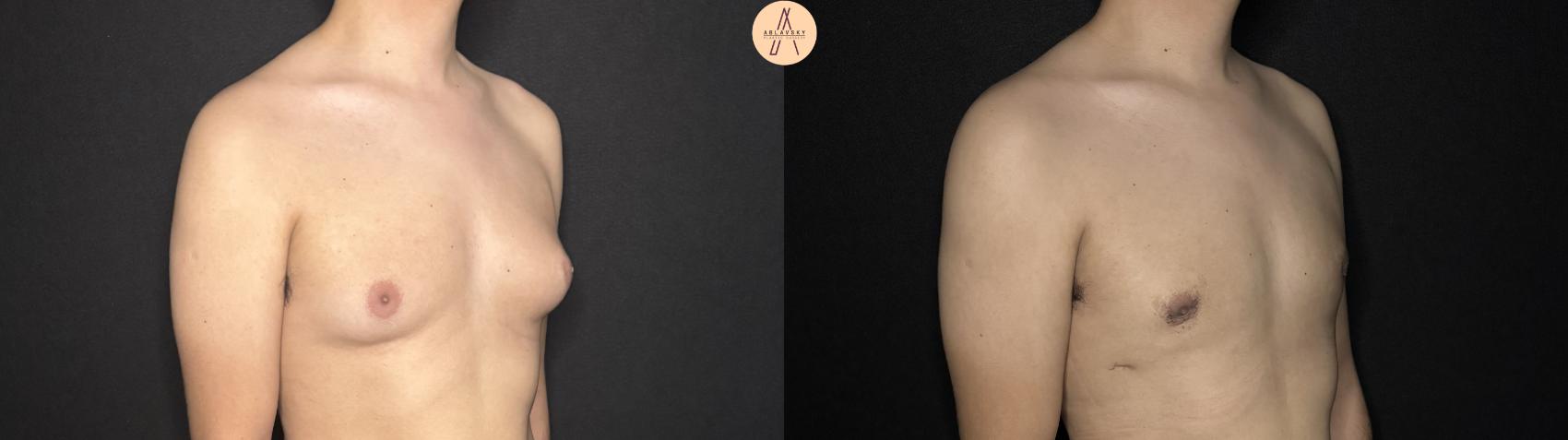 Before & After Liposuction Case 362 Right Oblique View in San Antonio, Texas