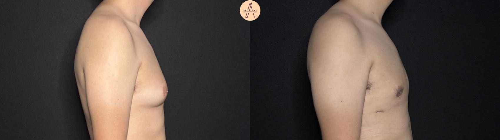 Before & After Liposuction Case 362 Right Side View in San Antonio, Texas
