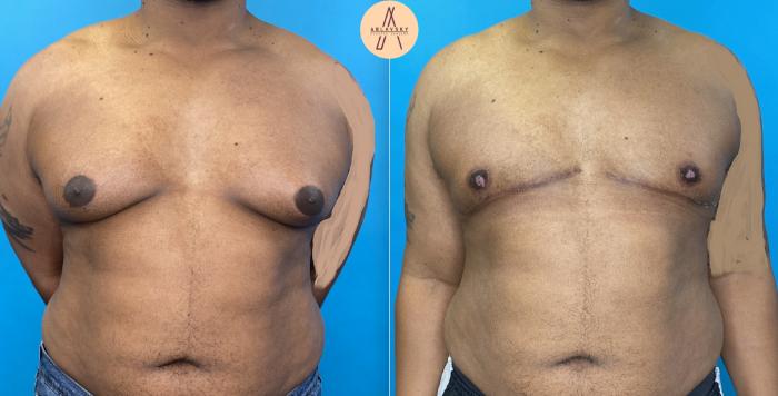 Before & After Gynecomastia Surgery Case 6 Front View in San Antonio, Texas