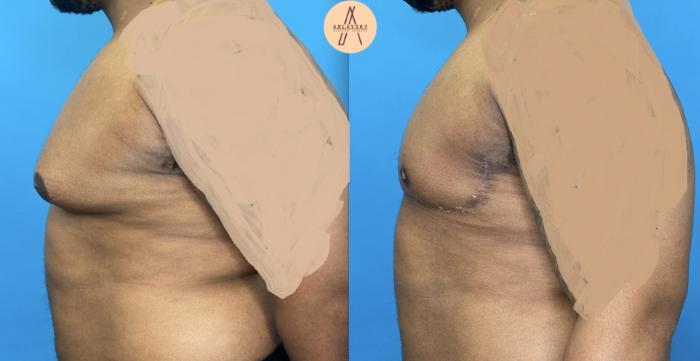 Before & After Gynecomastia Surgery Case 6 Left Side View in San Antonio, Texas