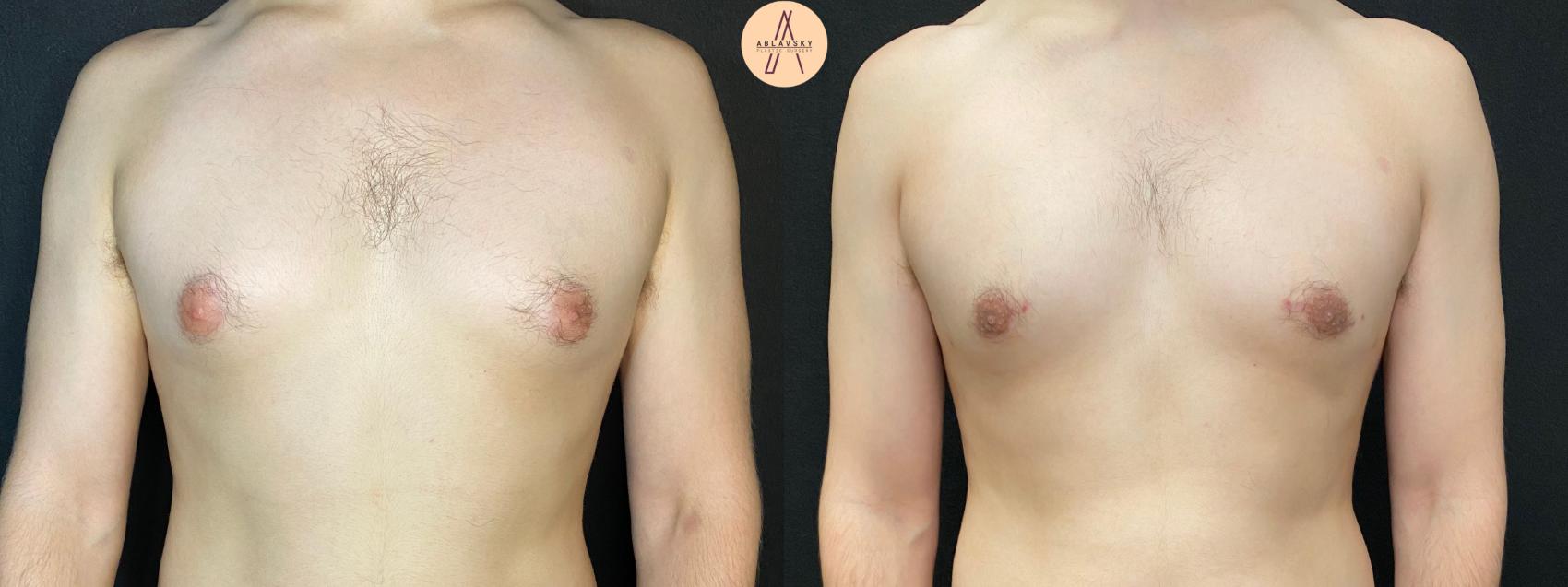 Before & After Gynecomastia Surgery Case 69 Front View in San Antonio, Texas