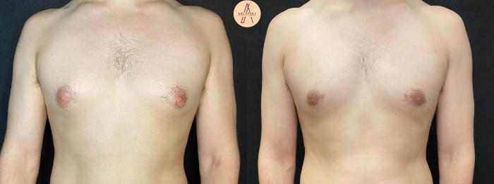 Before & After Gynecomastia Surgery Case 69 Front View in San Antonio, Texas