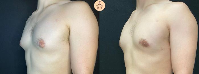 Before & After Gynecomastia Surgery Case 69 Left Oblique View in San Antonio, Texas