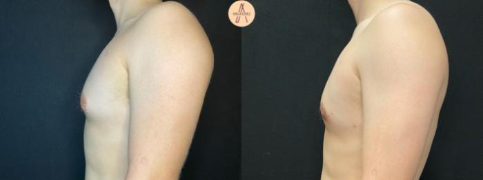 Before & After Gynecomastia Surgery Case 69 Left Side View in San Antonio, Texas