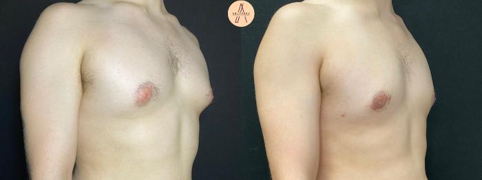 Before & After Gynecomastia Surgery Case 69 Right Oblique View in San Antonio, Texas