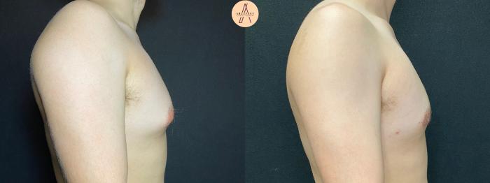 Before & After Gynecomastia Surgery Case 69 Right Side View in San Antonio, Texas