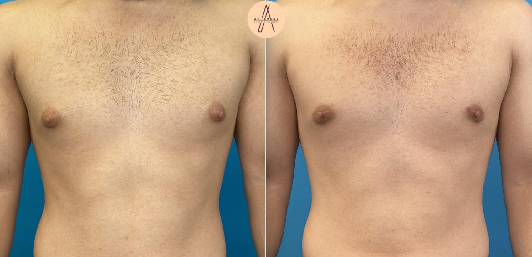 Before & After Gynecomastia Surgery Case 7 Front View in San Antonio, Texas