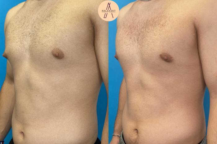 Before & After Gynecomastia Surgery Case 7 Left Oblique View in San Antonio, Texas