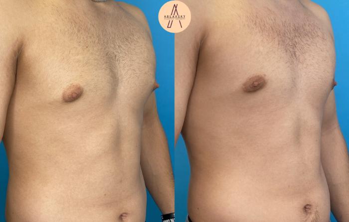 Before & After Gynecomastia Surgery Case 7 Right Oblique View in San Antonio, Texas