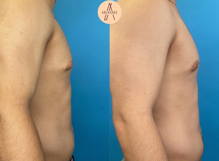 Before & After Gynecomastia Surgery Case 7 Right Side View in San Antonio, Texas