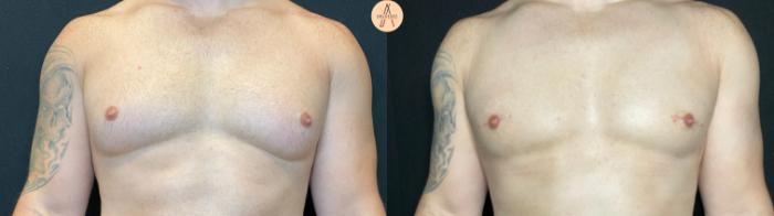 Before & After Gynecomastia Surgery Case 70 Front View in San Antonio, Texas