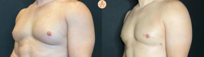 Before & After Gynecomastia Surgery Case 70 Left Oblique View in San Antonio, Texas