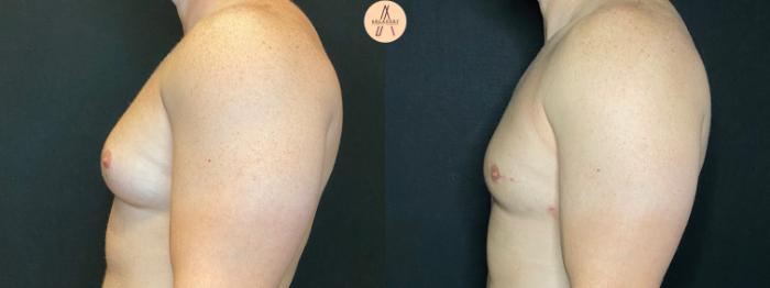 Before & After Liposuction Case 70 Left Side View in San Antonio, Texas