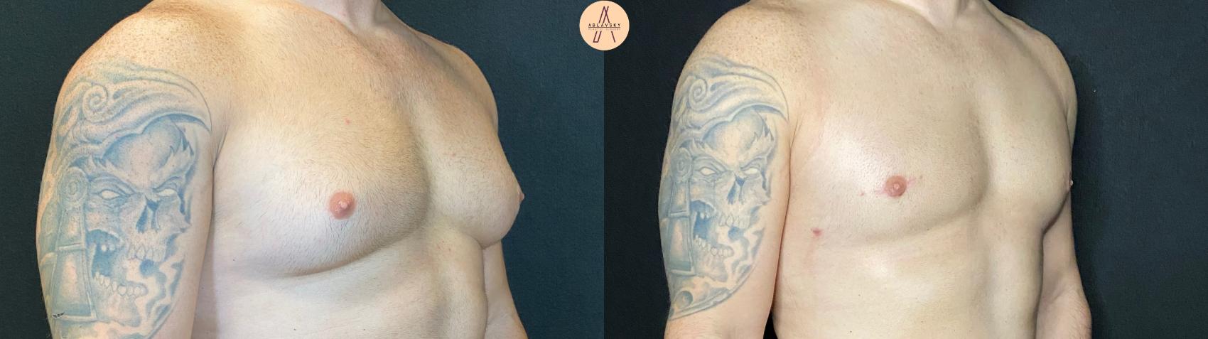 Before & After Liposuction Case 70 Right Oblique View in San Antonio, Texas