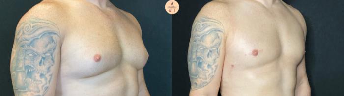 Before & After Gynecomastia Surgery Case 70 Right Oblique View in San Antonio, Texas