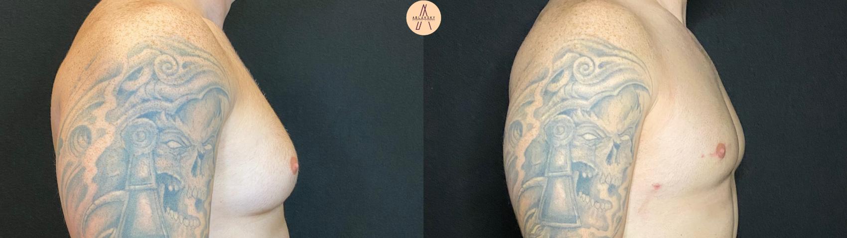 Before & After Liposuction Case 70 Right Side View in San Antonio, Texas