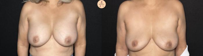 Before & After Implant removal Case 329 Front View in San Antonio, Texas