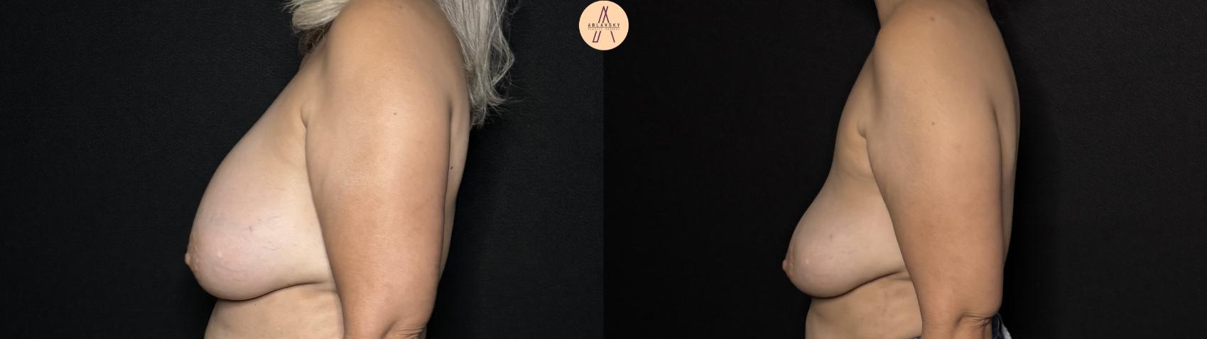 Before & After Implant removal Case 329 Left Side View in San Antonio, Texas