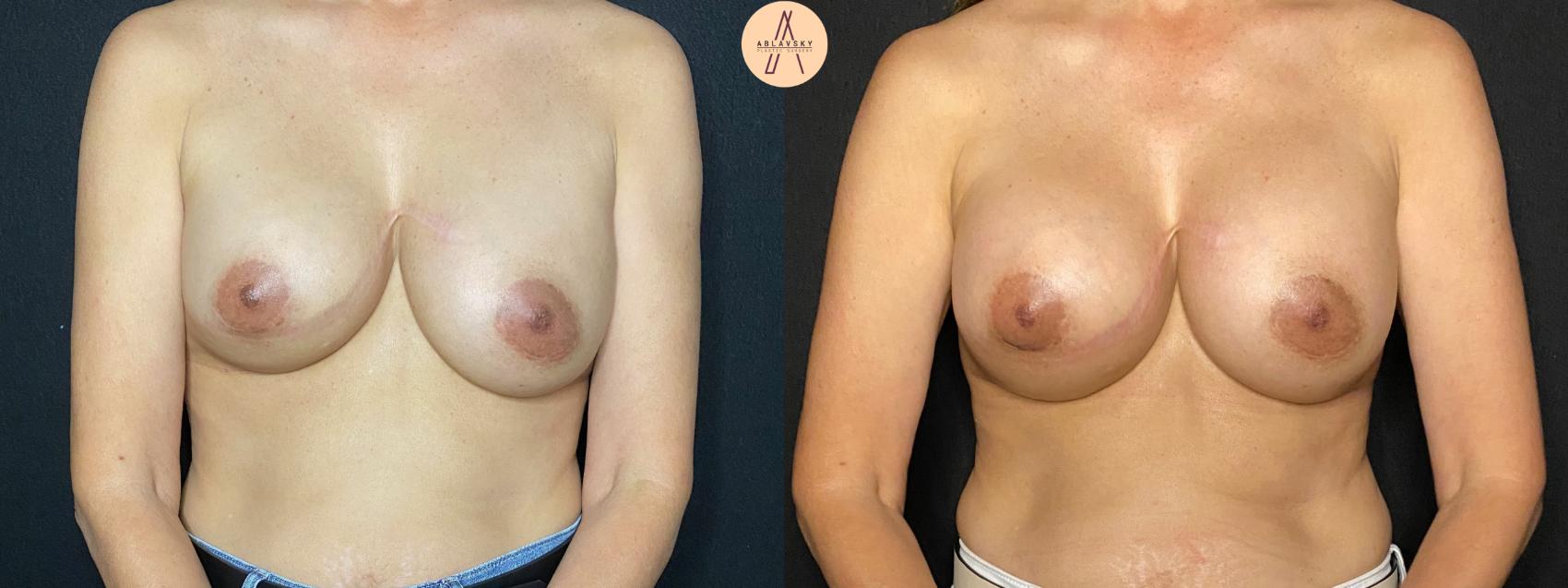 Before & After Breast Augmentation Case 120 Front View in San Antonio, Texas