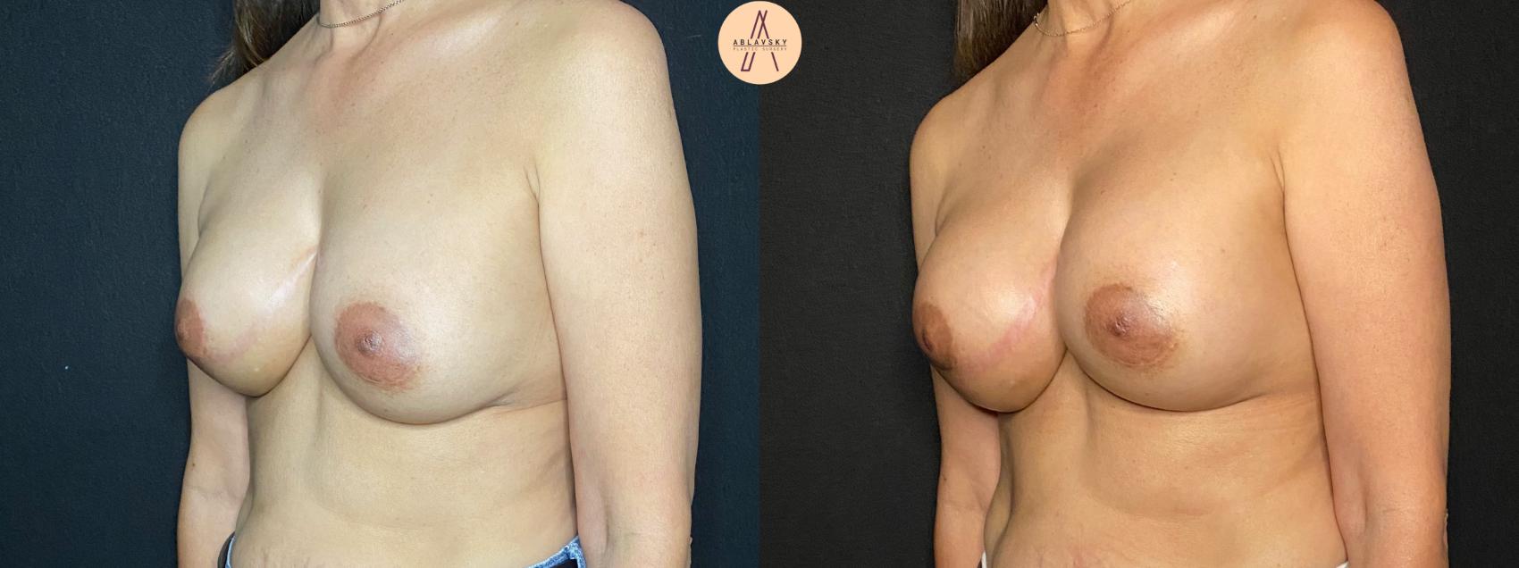 Before & After Implant Removal and Replacement  Case 120 Left Oblique View in San Antonio, Texas