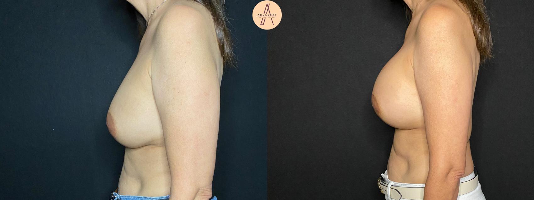 Before & After Implant Removal and Replacement  Case 120 Left Side View in San Antonio, Texas