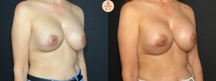 Before & After Implant Removal and Replacement  Case 120 Right Oblique View in San Antonio, Texas