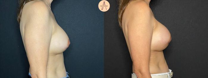 Before & After Implant Removal and Replacement  Case 120 Right Side View in San Antonio, Texas