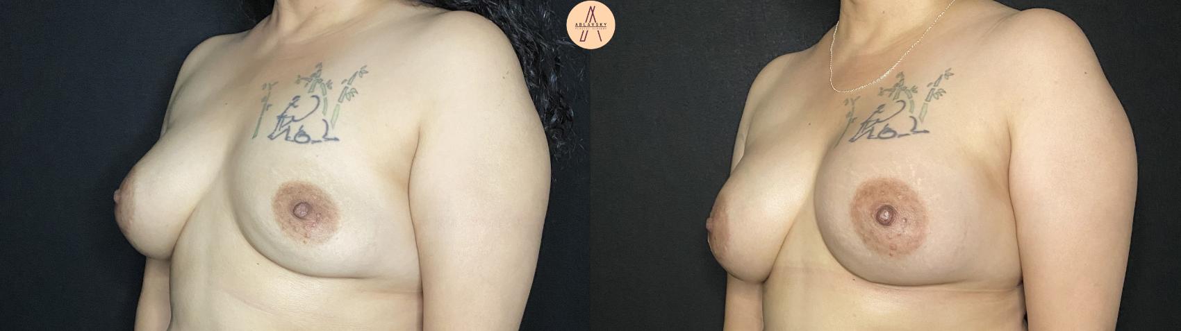 Before & After Implant Removal and Replacement  Case 146 Left Oblique View in San Antonio, Texas