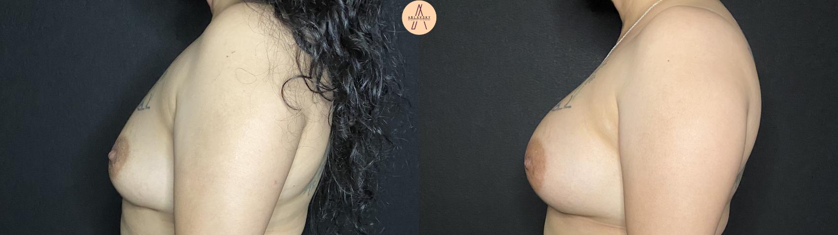 Before & After Implant Removal and Replacement  Case 146 Left Side View in San Antonio, Texas
