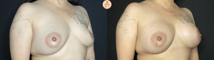 Before & After Implant Removal and Replacement  Case 146 Right Oblique View in San Antonio, Texas