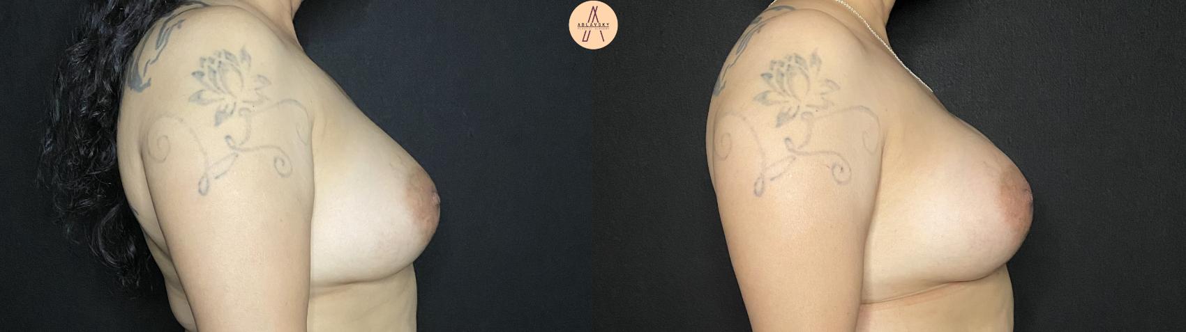 Before & After Implant Removal and Replacement  Case 146 Right Side View in San Antonio, Texas