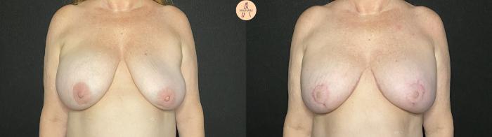 Before & After Breast Lift Case 155 Front View in San Antonio, Texas