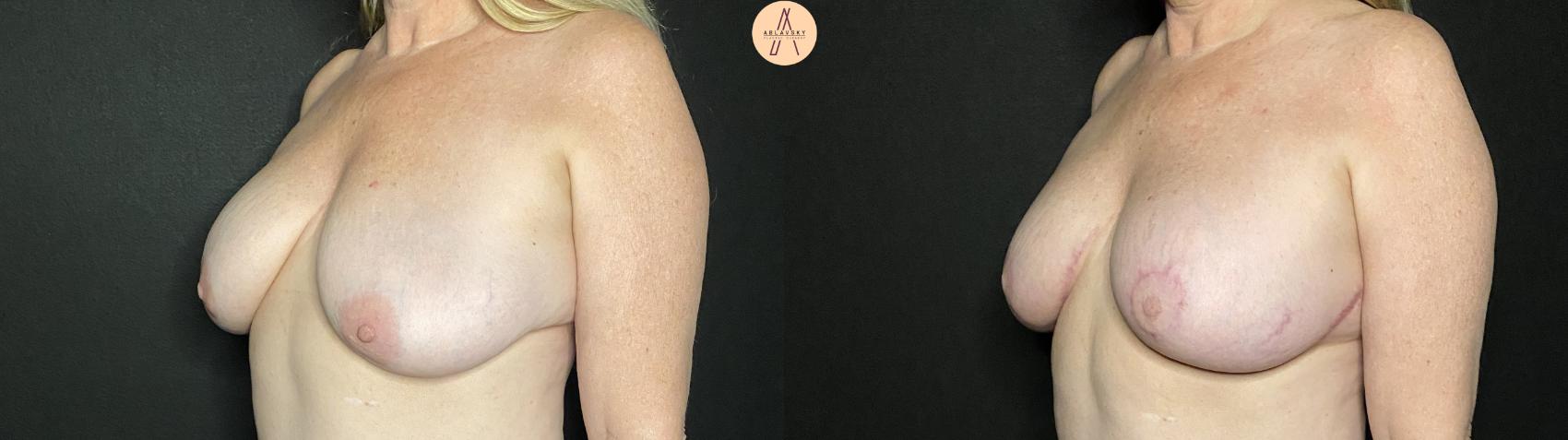 Before & After Implant Removal and Replacement  Case 155 Left Oblique View in San Antonio, Texas