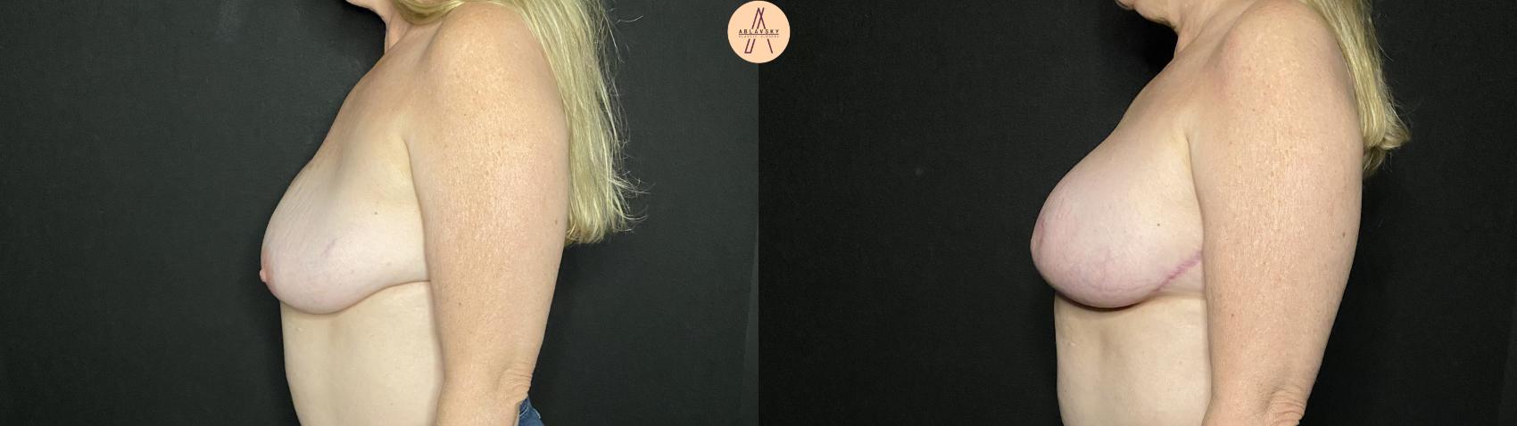 Before & After Implant Removal and Replacement  Case 155 Left Side View in San Antonio, Texas