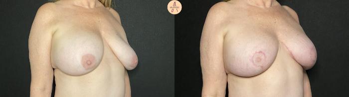 Before & After Implant Removal and Replacement  Case 155 Right Oblique View in San Antonio, Texas