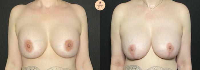 Before & After Breast Lift Case 159 Front View in San Antonio, Texas