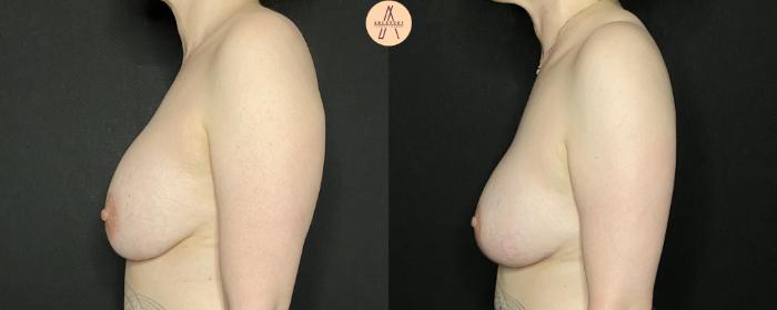 Before & After Breast Lift Case 159 Left Side View in San Antonio, Texas