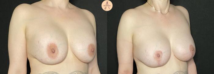 Before & After Breast Lift Case 159 Right Oblique View in San Antonio, Texas