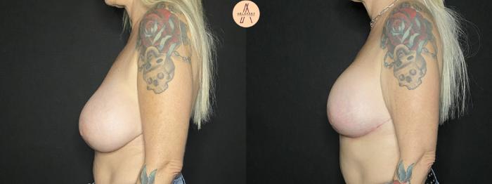 Before & After Implant Removal and Replacement  Case 166 Left Side View in San Antonio, Texas