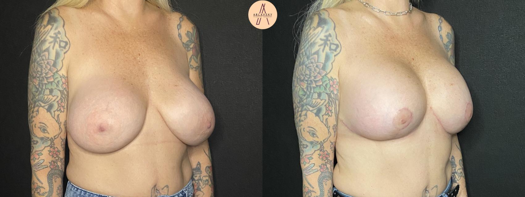 Before & After Implant Removal and Replacement  Case 166 Right Oblique View in San Antonio, Texas