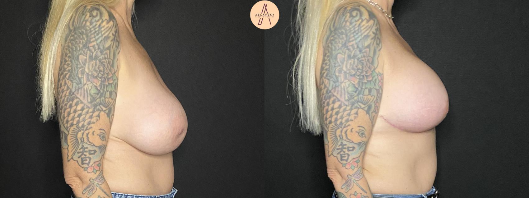 Before & After Implant Removal and Replacement  Case 166 Right Side View in San Antonio, Texas