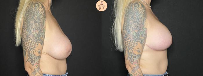 Before & After Breast Lift Case 166 Right Side View in San Antonio, Texas