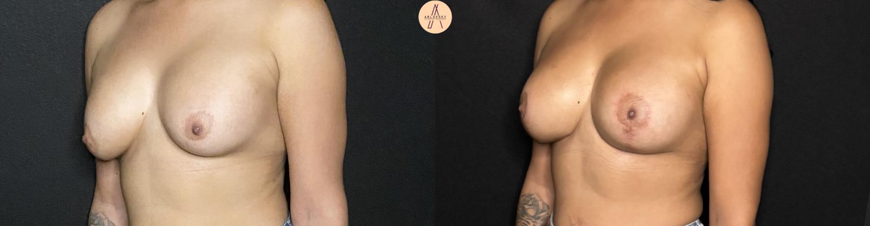 Before & After Implant Removal and Replacement  Case 246 Left Oblique View in San Antonio, Texas