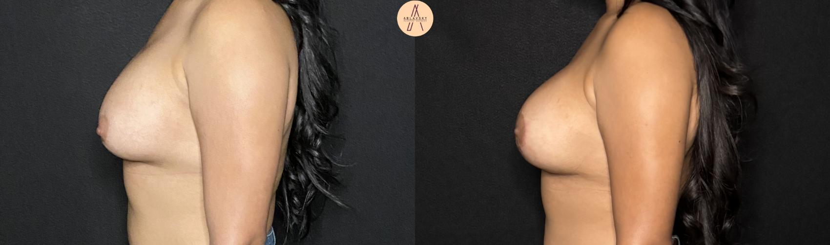 Before & After Implant Removal and Replacement  Case 246 Left Side View in San Antonio, Texas