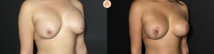 Before & After Implant Removal and Replacement  Case 246 Right Oblique View in San Antonio, Texas