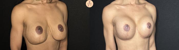 Before & After Implant Removal and Replacement  Case 256 Right Oblique View in San Antonio, Texas