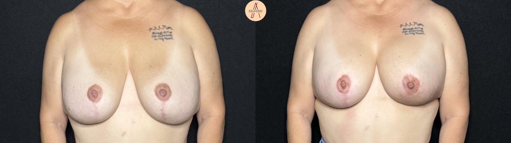 Before & After Implant Removal and Replacement  Case 278 Front View in San Antonio, Texas